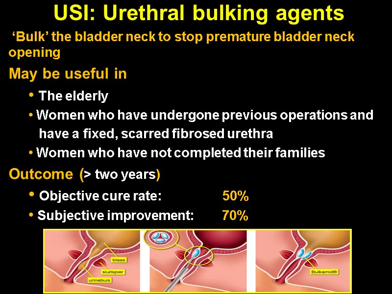 USI: Urethral bulking agents   ‘Bulk’ the bladder neck to stop premature bladder